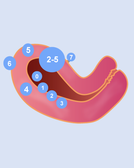 Miomas Uterinos Dr Adolfo Gabriel